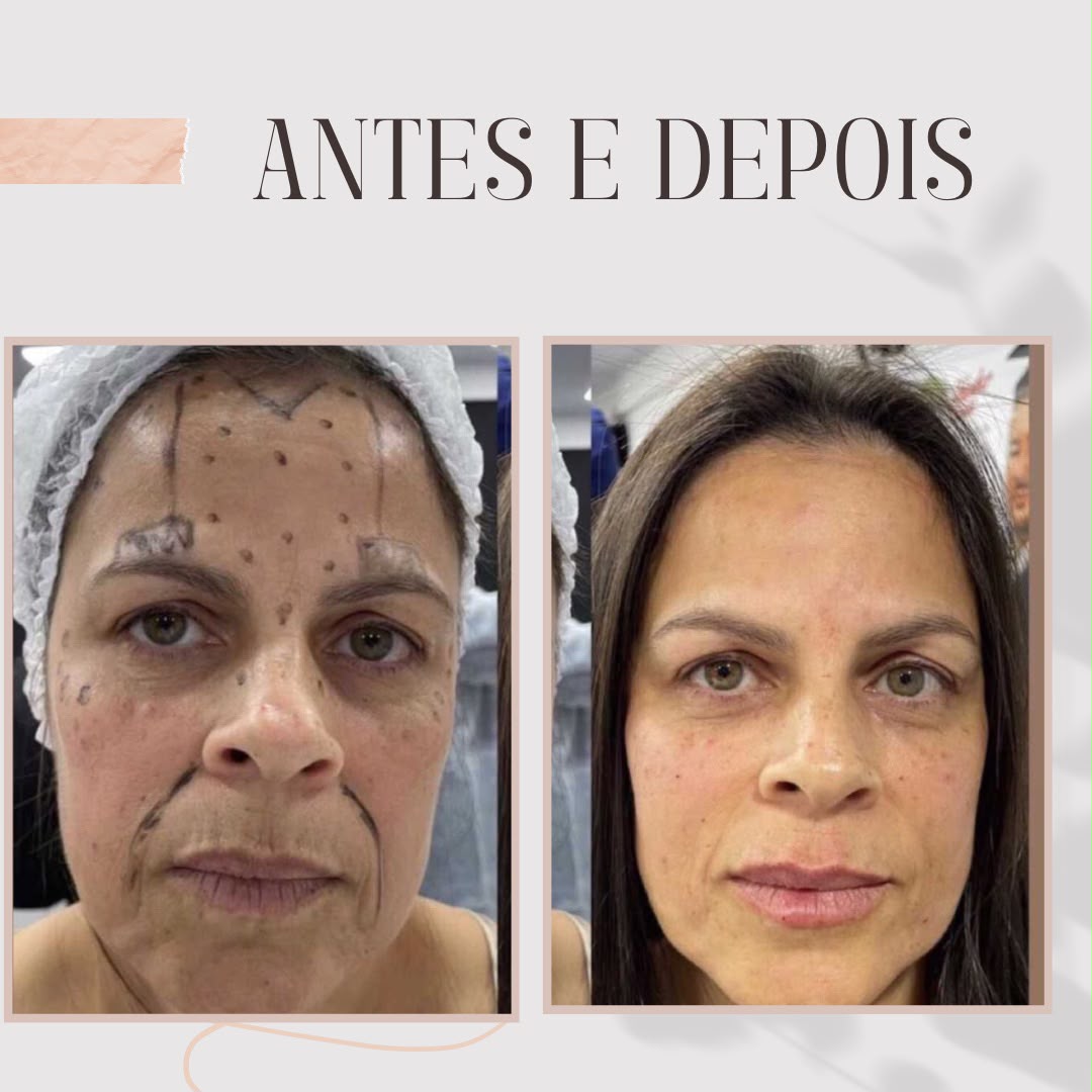 Resultado de tratamento estético — Espaço AME-SE+